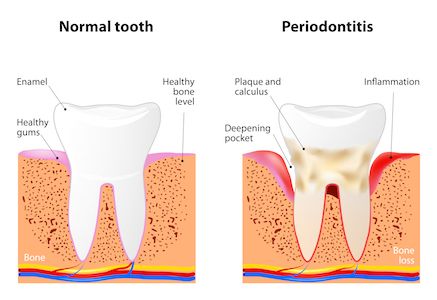 Image of how gum disease effects the gum line around the tooth and cause hard to reach plaque and calculus. 