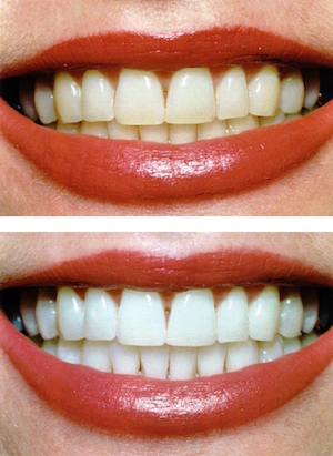 Before and after shot to show how teeth whitening can really make a smile shine. 