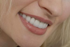 woman with dental veneers